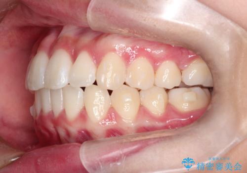 前歯のがたがたを綺麗にしたいの治療中