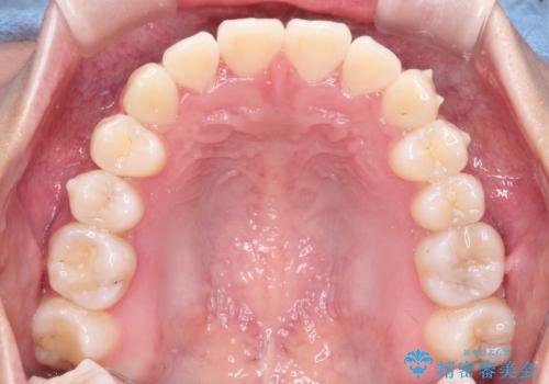 前歯のがたがたを綺麗にしたいの治療中