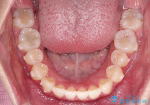 前歯のがたがたを綺麗にしたいの治療中