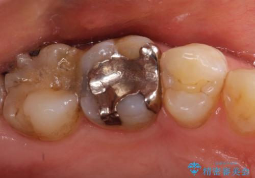 【オールセラミッククラウン】虫歯の治療の治療前