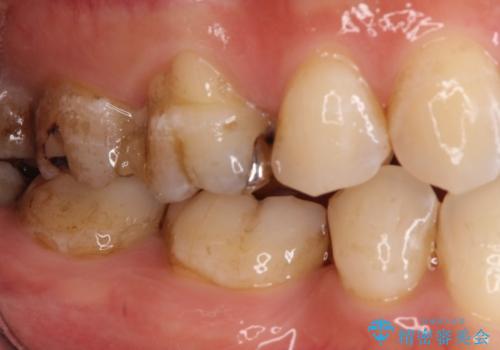 【オールセラミッククラウン】虫歯の治療の治療前