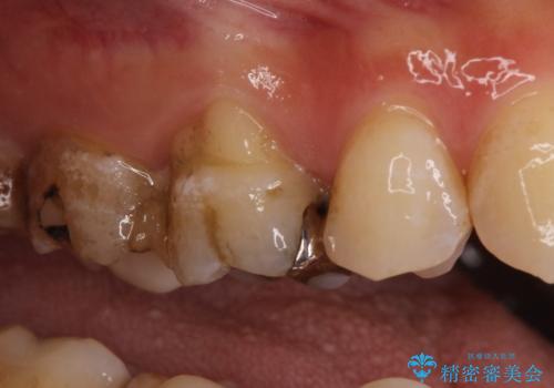 【オールセラミッククラウン】虫歯の治療の治療前