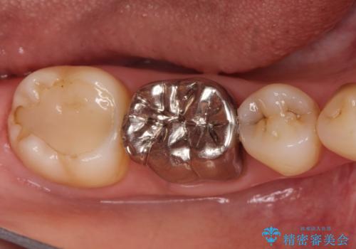 【オールセラミッククラウン】存在感のある銀歯を外したいの治療前