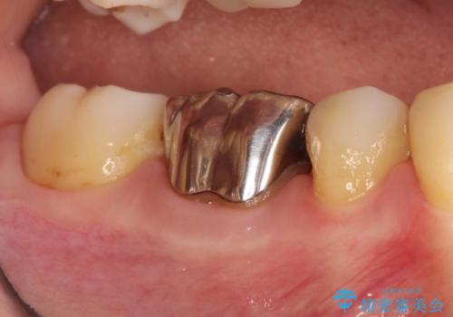 【オールセラミッククラウン】存在感のある銀歯を外したいの症例 治療前