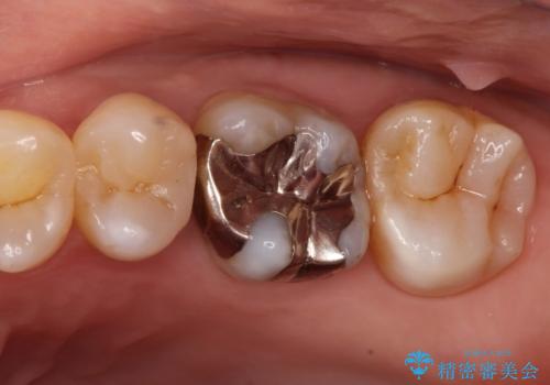 【メタルフリー】矯正後に歯を白くしたい。の治療前