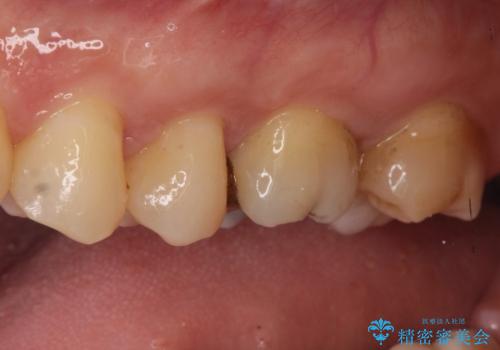 【メタルフリー】矯正後に歯を白くしたい。の治療前