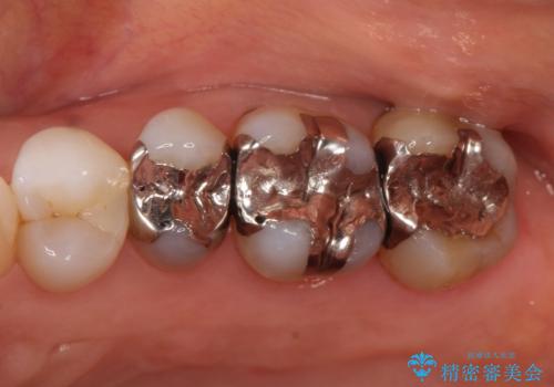 【メタルフリー】セラミックインレーによる治療の症例 治療前