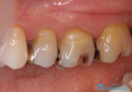 【メタルフリー】セラミックインレーによる治療の治療前