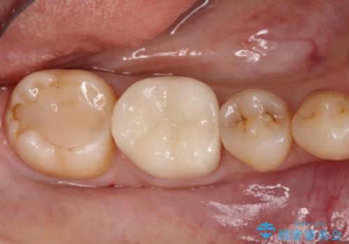 【オールセラミッククラウン】存在感のある銀歯を外したいの治療後