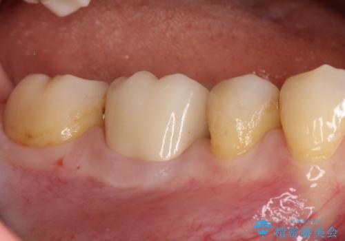 【オールセラミッククラウン】存在感のある銀歯を外したいの症例 治療後