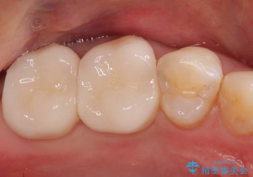 【オールセラミッククラウン】虫歯の治療の治療後