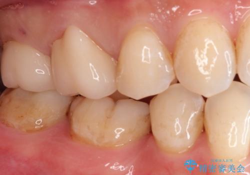 【オールセラミッククラウン】虫歯の治療の治療後