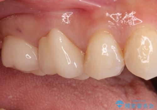 【オールセラミッククラウン】虫歯の治療の治療後