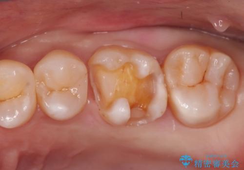 【メタルフリー】矯正後に歯を白くしたい。の治療中