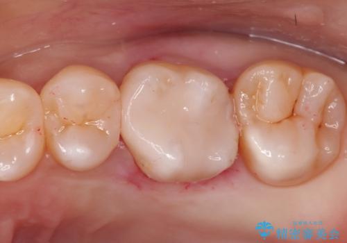 【メタルフリー】矯正後に歯を白くしたい。の治療後