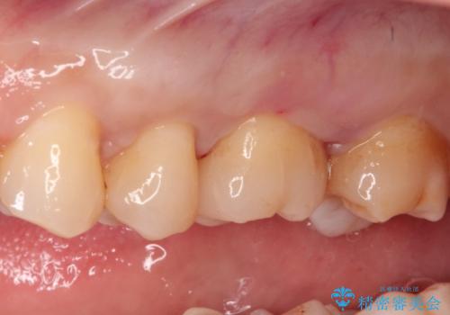 【メタルフリー】矯正後に歯を白くしたい。の治療後