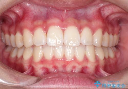 前歯のがたがたを綺麗にしたいの症例 治療後