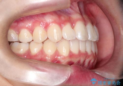 前歯のがたがたを綺麗にしたいの治療後