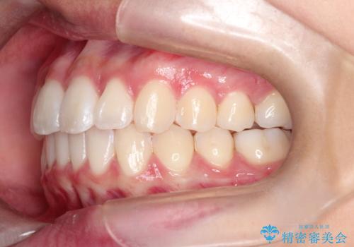 前歯のがたがたを綺麗にしたいの治療後