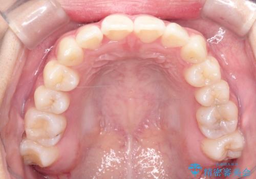 前歯のがたがたを綺麗にしたいの治療後