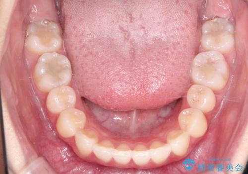 前歯のがたがたを綺麗にしたいの治療後