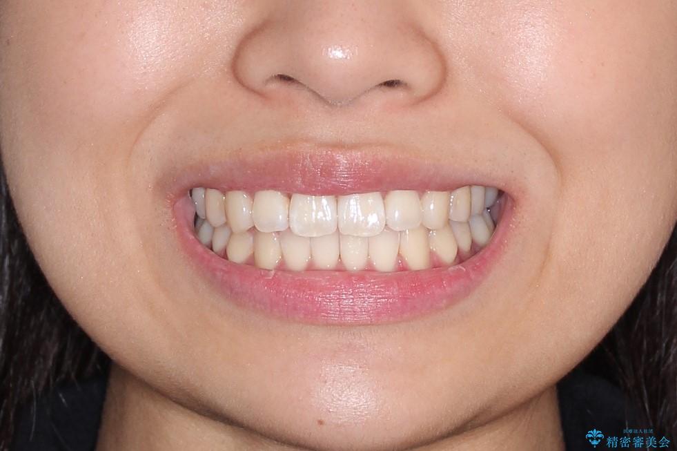 前歯のがたがたを綺麗にしたいの治療後(顔貌)