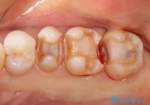 【メタルフリー】セラミックインレーによる治療の治療中