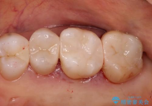 【メタルフリー】セラミックインレーによる治療の症例 治療後