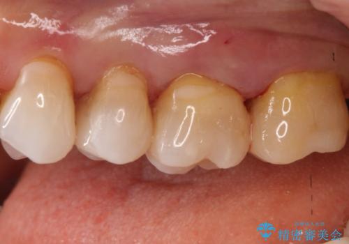 【メタルフリー】セラミックインレーによる治療の治療後
