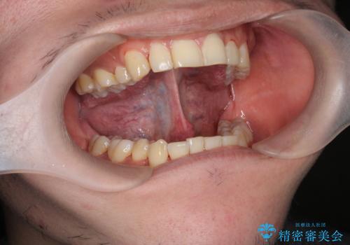 舌小帯の形成で達成する滑舌の改善の治療前