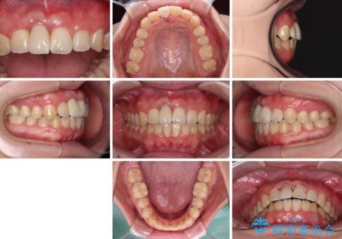 怪我をして不格好な前歯 矯正治療とインプラント補綴治療の治療後