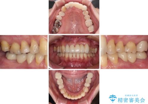気になる所を一気に治療 総合歯科治療の治療後