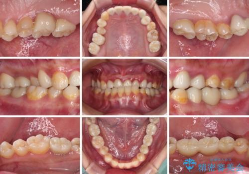 むし歯だらけの奥歯　セラミッククラウンによるむし歯治療の治療後