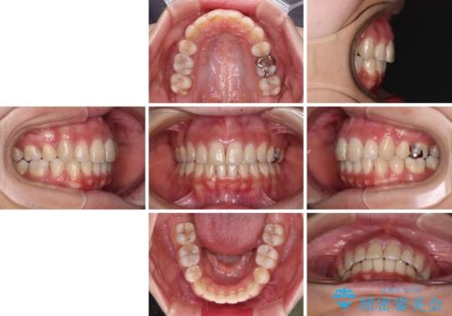突出した口元が気になる ハーフリンガル装置による抜歯矯正の治療後