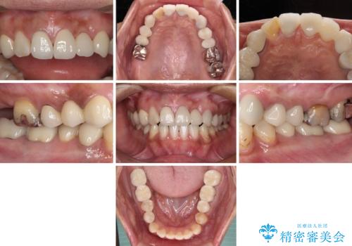以前治療した歯が続々とむし歯に 全顎むし歯治療の治療後