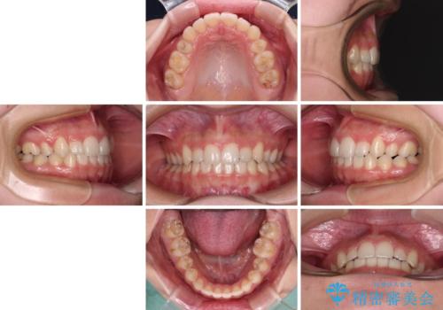 目立つ八重歯を目立たない装置で　ハーフリンガルによる抜歯矯正の治療後