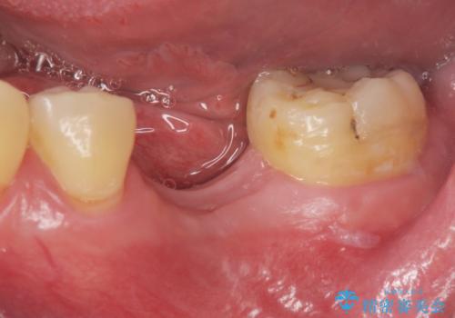 インプラントによる咬合機能回復の症例 治療前