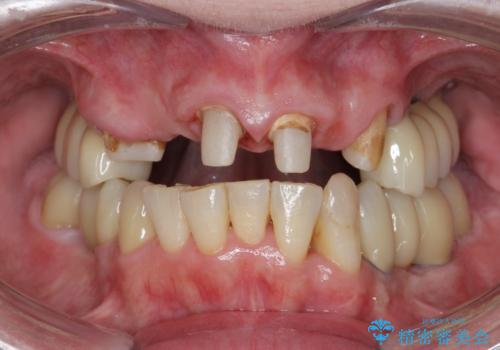 多発した虫歯による咬合崩壊    インプラントを用いた全顎治療の治療中