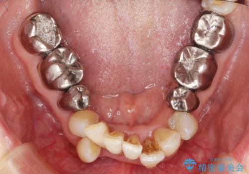 矯正治療とセラミック治療で口腔内環境を劇的に改善の治療前