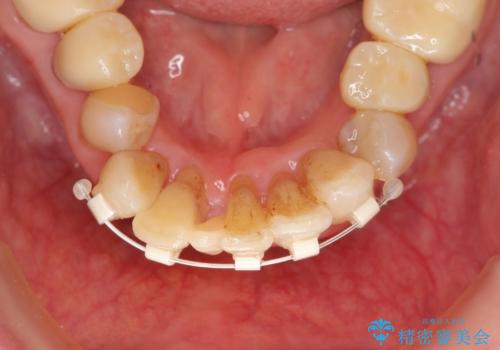 矯正治療とセラミック治療で口腔内環境を劇的に改善の治療中