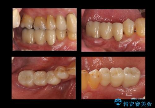 60代男性　奥歯のブリッジ　倒れこんでいる奥歯を部分矯正の症例 治療後