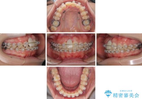 怪我をして不格好な前歯 矯正治療とインプラント補綴治療の治療中