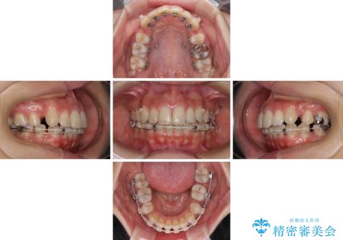 突出した口元が気になる ハーフリンガル装置による抜歯矯正の治療中