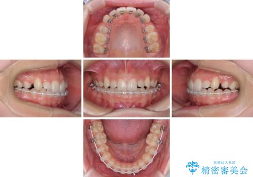 目立つ八重歯を目立たない装置で　ハーフリンガルによる抜歯矯正の治療中