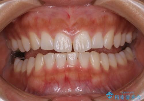 矯正治療前にホワイトニングの治療後