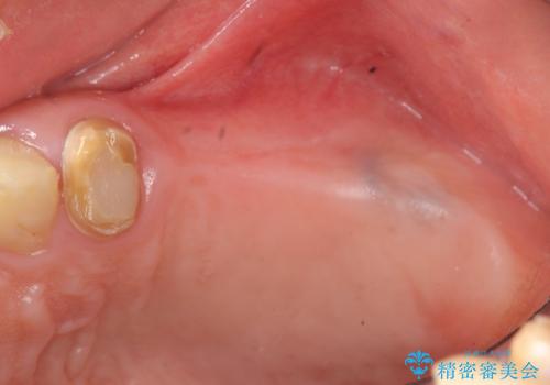 インプラント治療で達成する奥歯のしっかりとした咬合の治療前