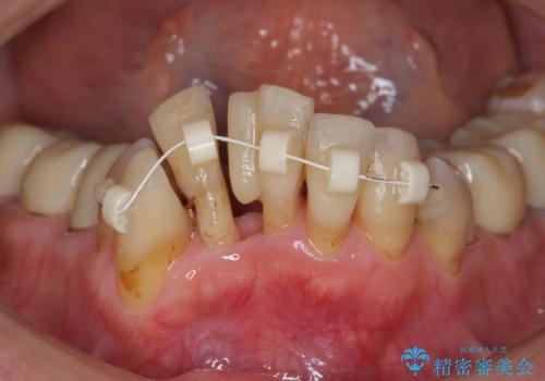 矯正治療とセラミック治療で口腔内環境を劇的に改善の治療前