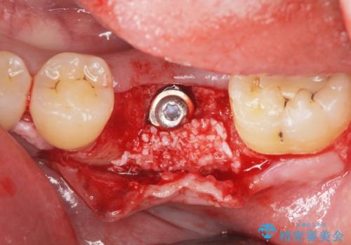 インプラントによる咬合機能回復の治療中
