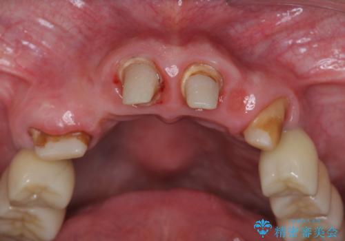 多発した虫歯による咬合崩壊    インプラントを用いた全顎治療の治療中