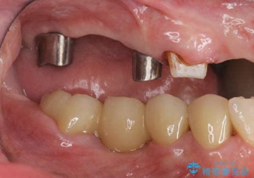 多発した虫歯による咬合崩壊    インプラントを用いた全顎治療の治療中